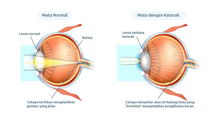 Kenali Katarak Gejala Hingga Pencegahan Dan Pengobatannya